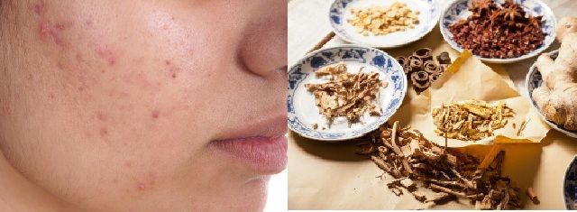 bài thuốc đông y trị mụn hiệu quả