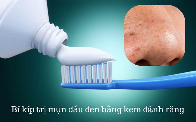 cách trị mụn đầu đen bằng kem đánh răng