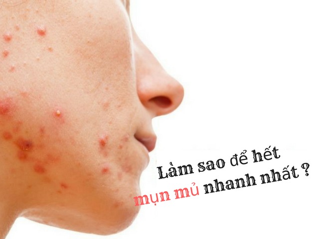 Việc tìm ra cách trị mụn mủ hiệu quả là mong muốn của nhiều người