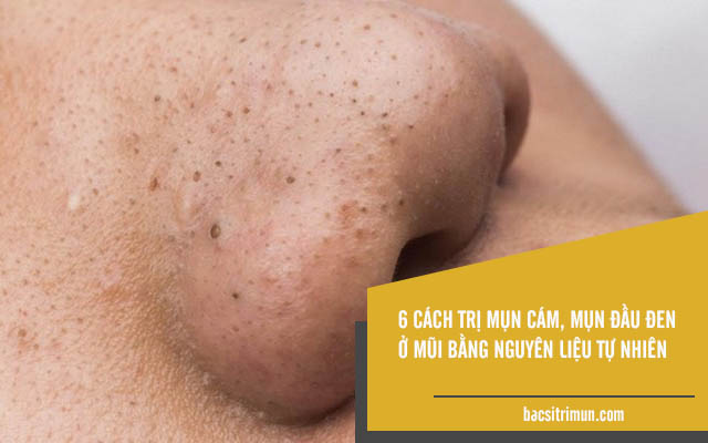 trị mụn cám và mụn đầu đen