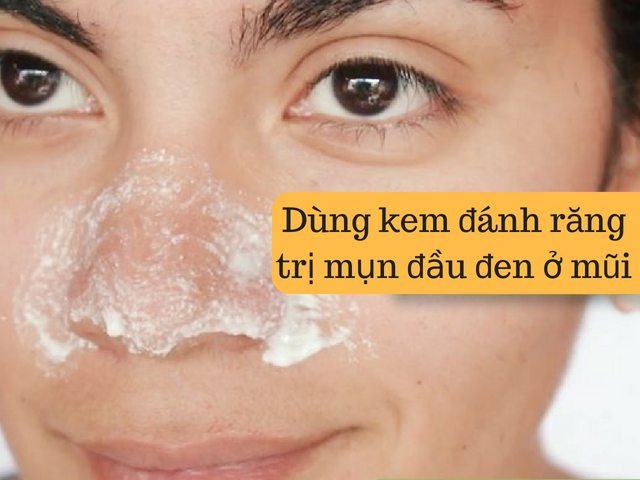 cách trị mụn đầu đen ở mũi hiệu quả bằng kem đánh răng 