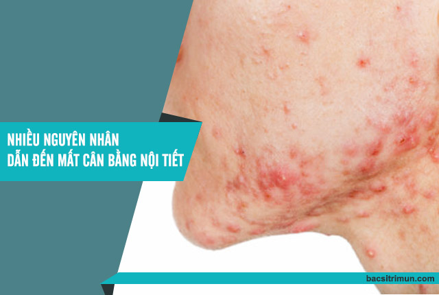 nguyên nhân gây ra mụn trứng cá do nội tiết