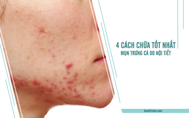 mụn trứng cá do nội tiết