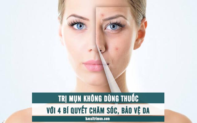 trị mụn không dùng thuốc