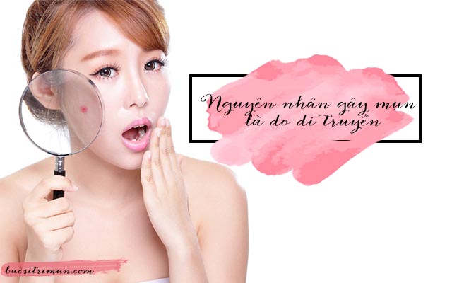 Nguyên nhân bị mụn do di truyền