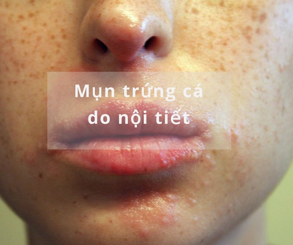 Mụn trứng cá do nội tiết là một trong các loại mụn trứng cá thường gặp