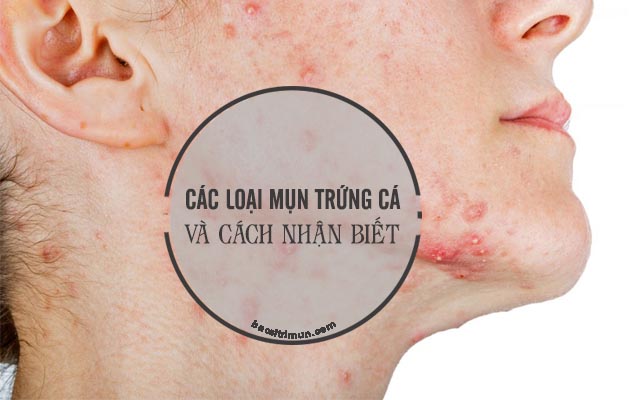 các loại mụn trứng cá