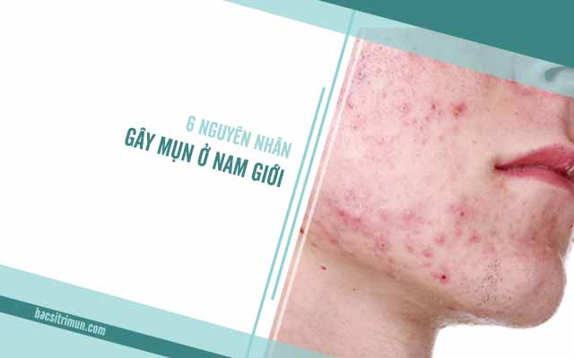 các nguyên nhân gây mụn ở nam giới