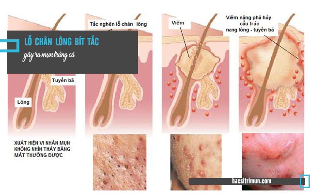 sự thật về mụn trứng cá - mụn xuất phát từ nang lông