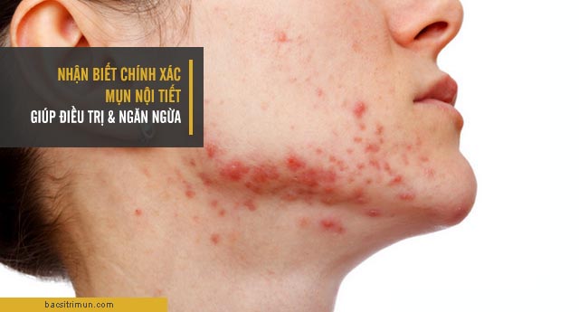làm sao biết bị mụn nội tiết qua nguyên nhân