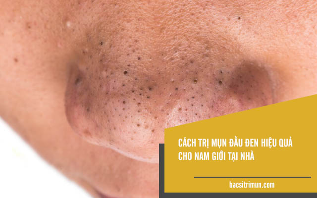 cách trị mụn đầu đen hiệu quả cho nam giới