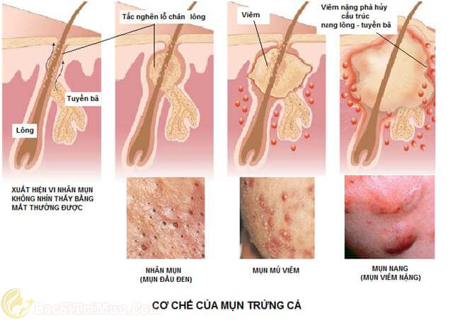 Cơ chế hình thành mụn trứng cá bọc mủ