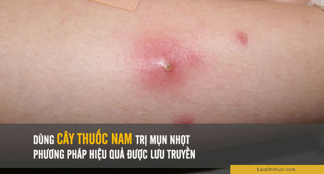 cây thuốc nam trị mụn nhọt 