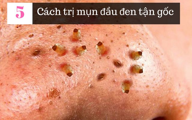 Cách trị mụn đầu đen hiệu quả