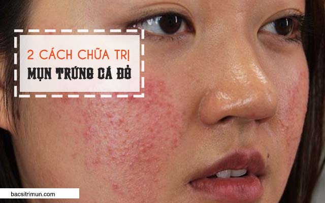 Cách trị mụn trứng cá đỏ