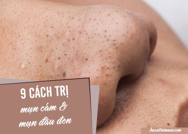 Cách trị mụn cám và mụn đầu đen