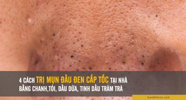 Cách trị mụn đầu đen cấp tốc