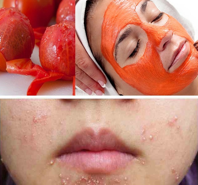 Đắp mặt nạ trị mụn trứng cá từ cà chua