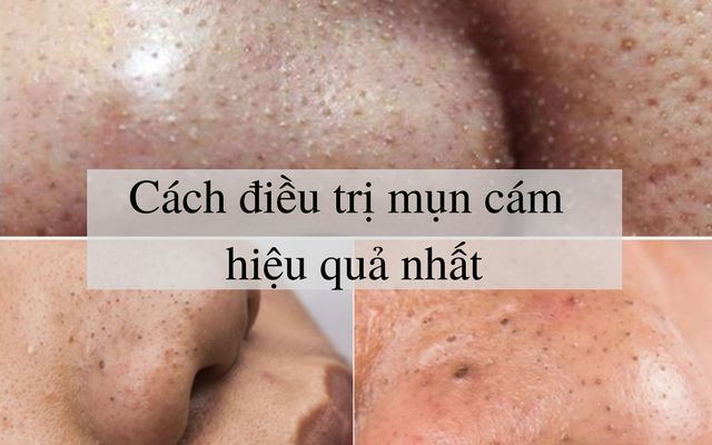 Cách trị mụn cám hiệu quả