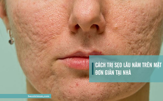 cách trị sẹo lâu năm trên mặt