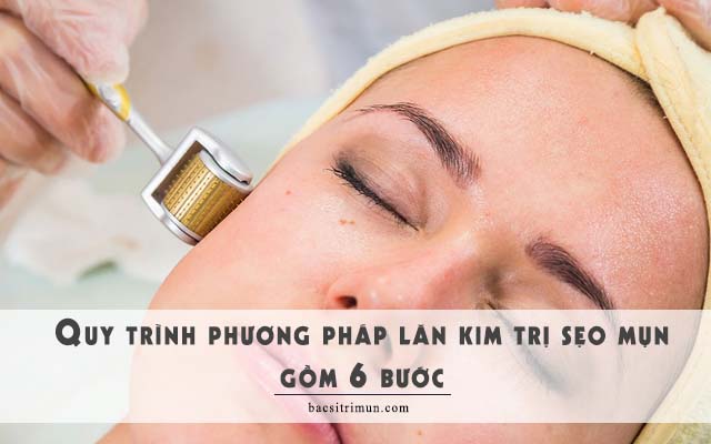 quy trình lăn kim trị sẹo mụn