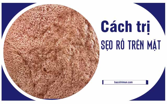 cách trị sẹo rỗ trên mặt tại nhà