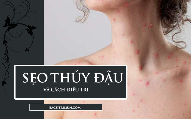 thuốc trị sẹo thủy đậu hiệu quả nhất