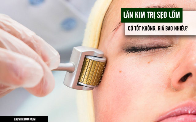 lăn kim trị sẹo lõm có tốt không?