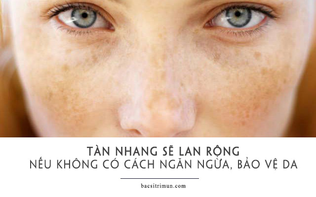 tàn nhang có lan ra không