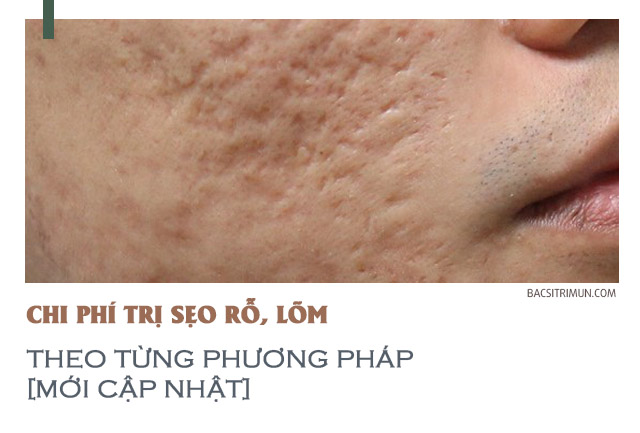 chi phí trị sẹo lõm