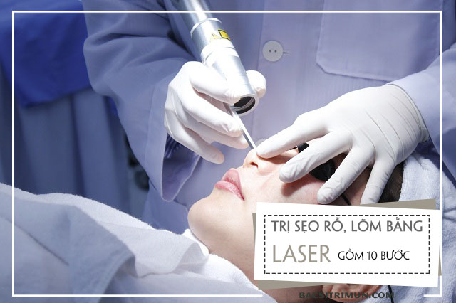 Quy trình trị sẹo rỗ bằng laser