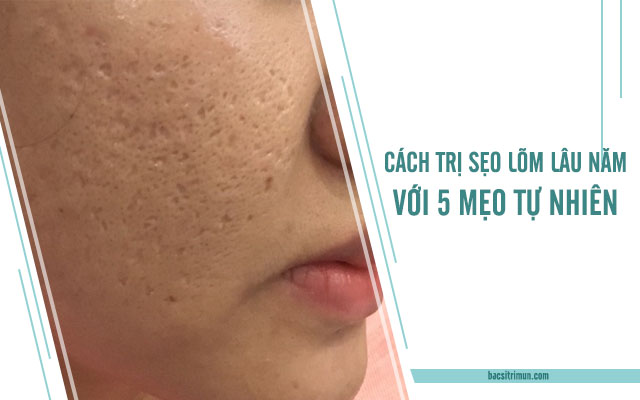 trị sẹo lõm lâu năm