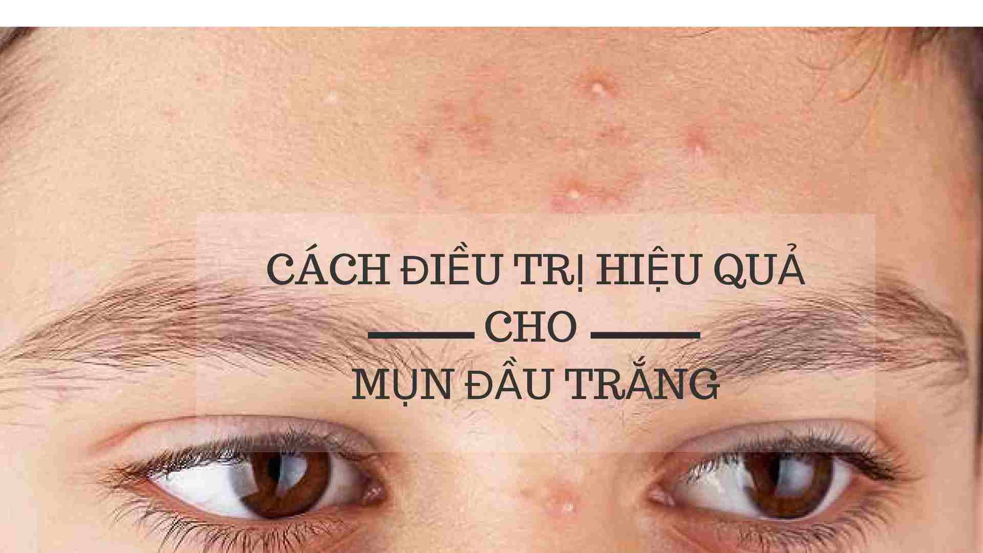 cách trị mụn đầu trắng