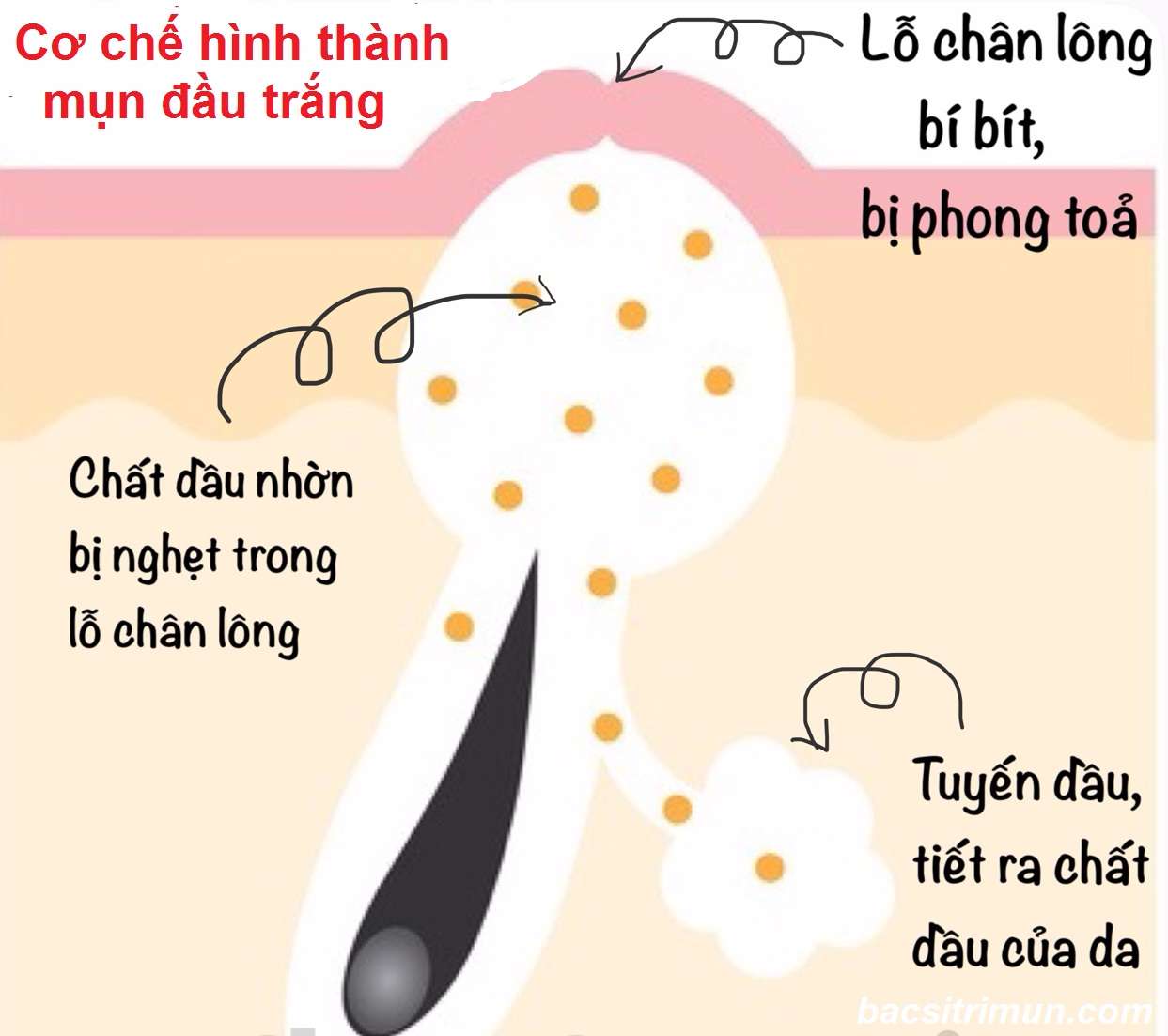 Cơ chế hình thành mụn đầu trắng