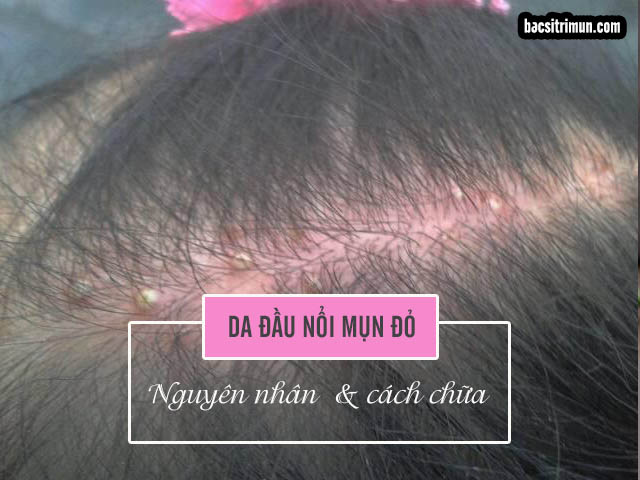 Da đầu nổi mụn đỏ