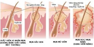 Mụn đầu đen bị viêm - Do nặn mụn sai cách -1