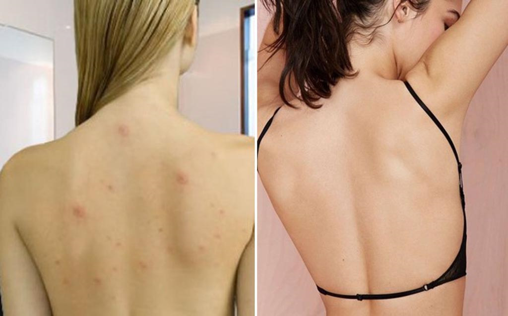 Làm sao để hết mụn và vết thâm ở lưng?