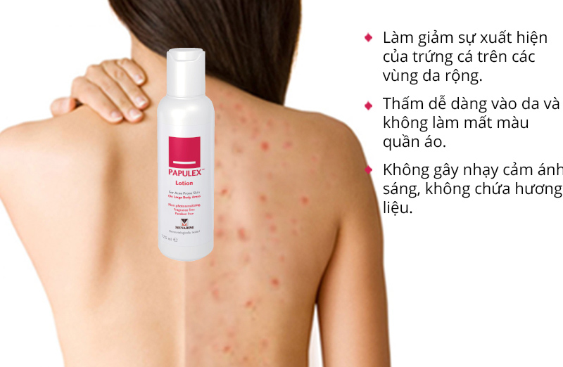 Thuốc trị mụn lưng Papulex lotion 125ml giá bao nhiêu, mua ở đâu?