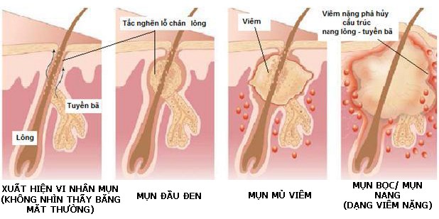 Bị nổi nhiều mụn ở lưng là bệnh gì?