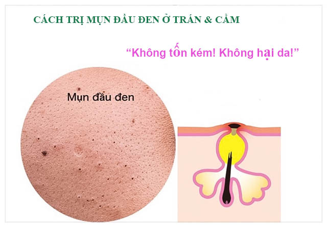 mụn đầu đen ở trán