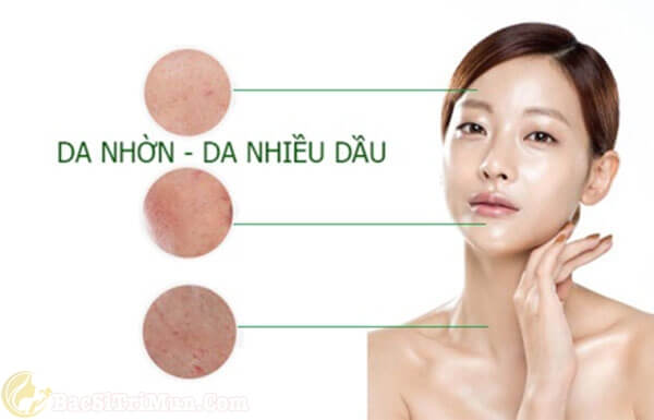 Chọn kem trị mụn trứng cá cho da nhờn