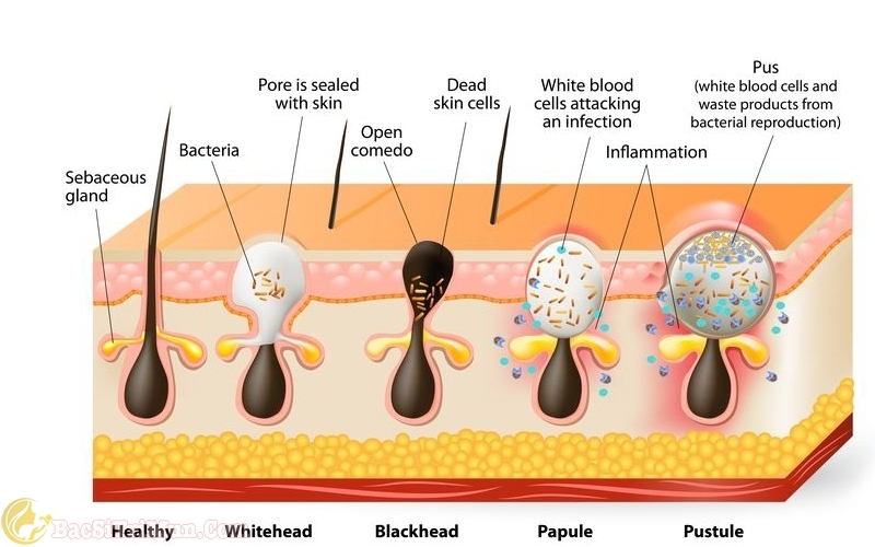 Làn da giảm mụn nhờ sử dụng sữa rửa mặt chứa Axit salicylic