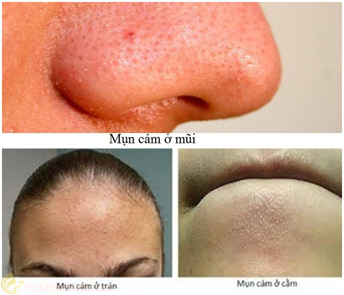 cách trị mụn cám bằng kem đánh răng 