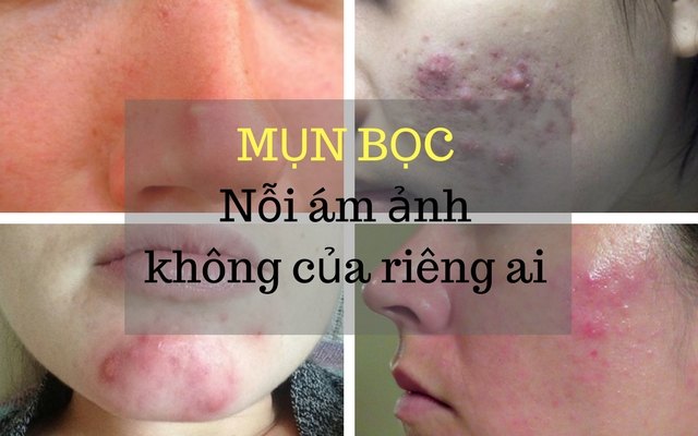 cách trị mụn bọc tại nhà hiệu quả nhất