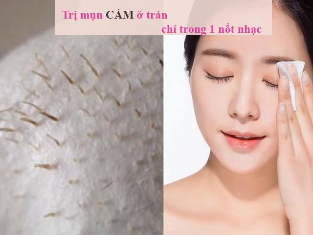 Cách trị mụn cám trên trán hiệu quả