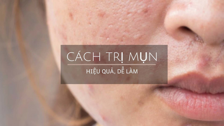 Việc tìm ra cách trị mụn hiệu quả là mong muốn của nhiều người