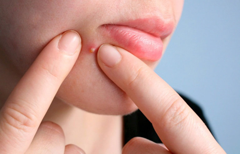 Trị mụn bằng phương pháp nặn không được khuyến khích vì nó gây nhiễm khuẩn, làm tăng nguy cơ bị sẹo thâm