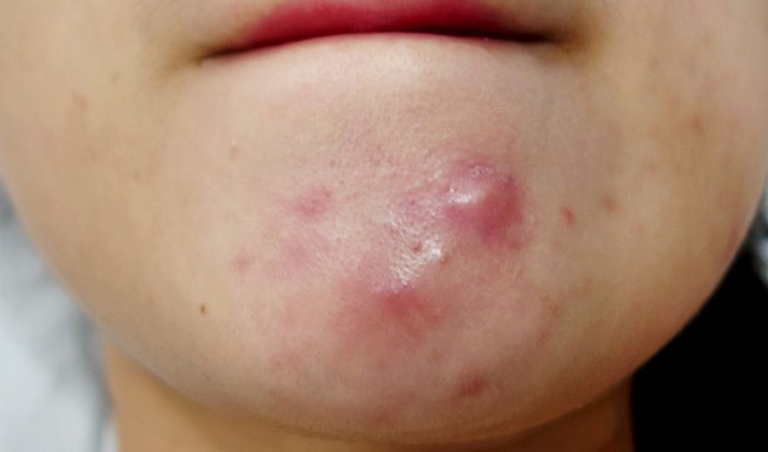 Mụn bọc là một trong các loại mụn trứng cá thường gặp