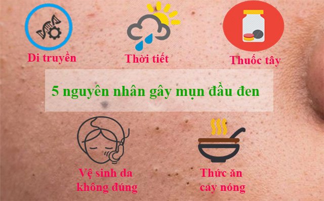 Nguyên nhân gây mụn đầu đen ở má