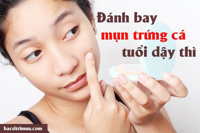 Cách trị mụn trứng cá ở tuổi dậy thì 